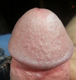 Photo of the enlarged glans of the penis