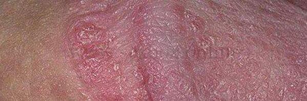 Dry skin and penis head ulcers after using sodium bicarbonate