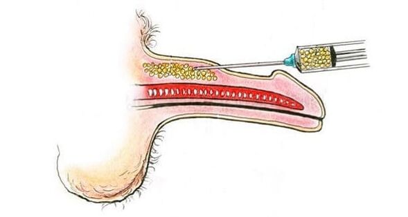 Muscle tissue transplant to enlarge the penis.