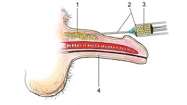 Hyaluronic acid injection to thicken the penis.
