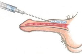 A dangerous method to enlarge the penis using Vaseline injections.